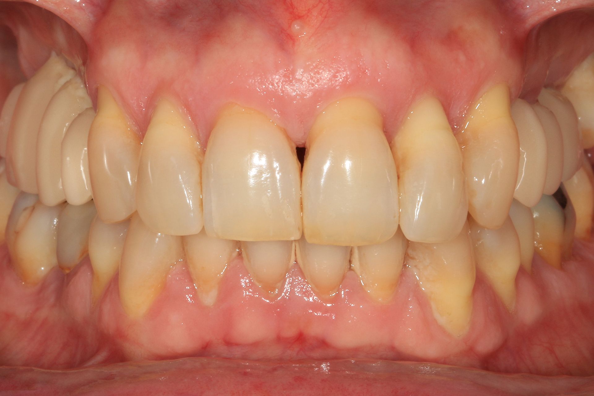 Figura 26. Imagen de la carga inmediata realizada en el paciente varias horas tras la colocación de los implantes dentales.