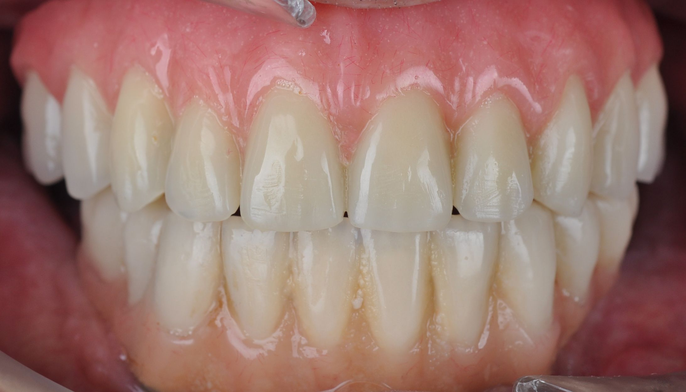 Figure 19. Intraoral photograph of the patient with the completed rehabilitation.