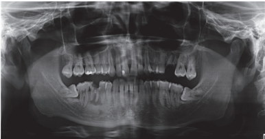 Figure 3. Panoramic radiograph showing the presence of rootdebris associated to apical radiolucent images in 2.6 and 4.6, in addition to the presence of the lower third molars retained in a horizontal position.