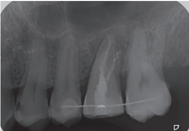 Figure 18. Periapical radiograph after 2 months of theautotransplant.Figure 18. Periapical radiograph after 2 months of the
autotransplant.