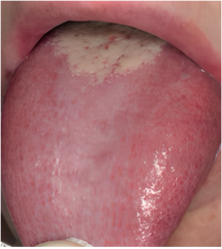 Figure 1. Reticular lichen planus in dorsum of the tongue and saburral tongue.