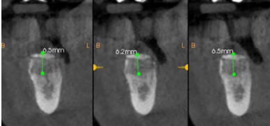 Figura 8. Corte ortorradial del CBCT donde se observa laganancia ósea vertical.
