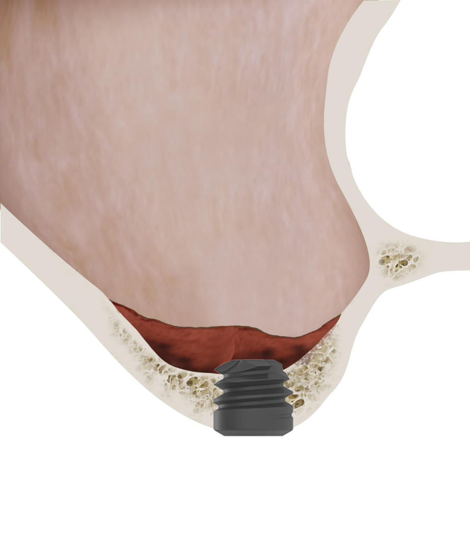 Figures 12 and 13. Schematic of a transcrestal lift for the insertion of the implant in the area corresponding to the 26.