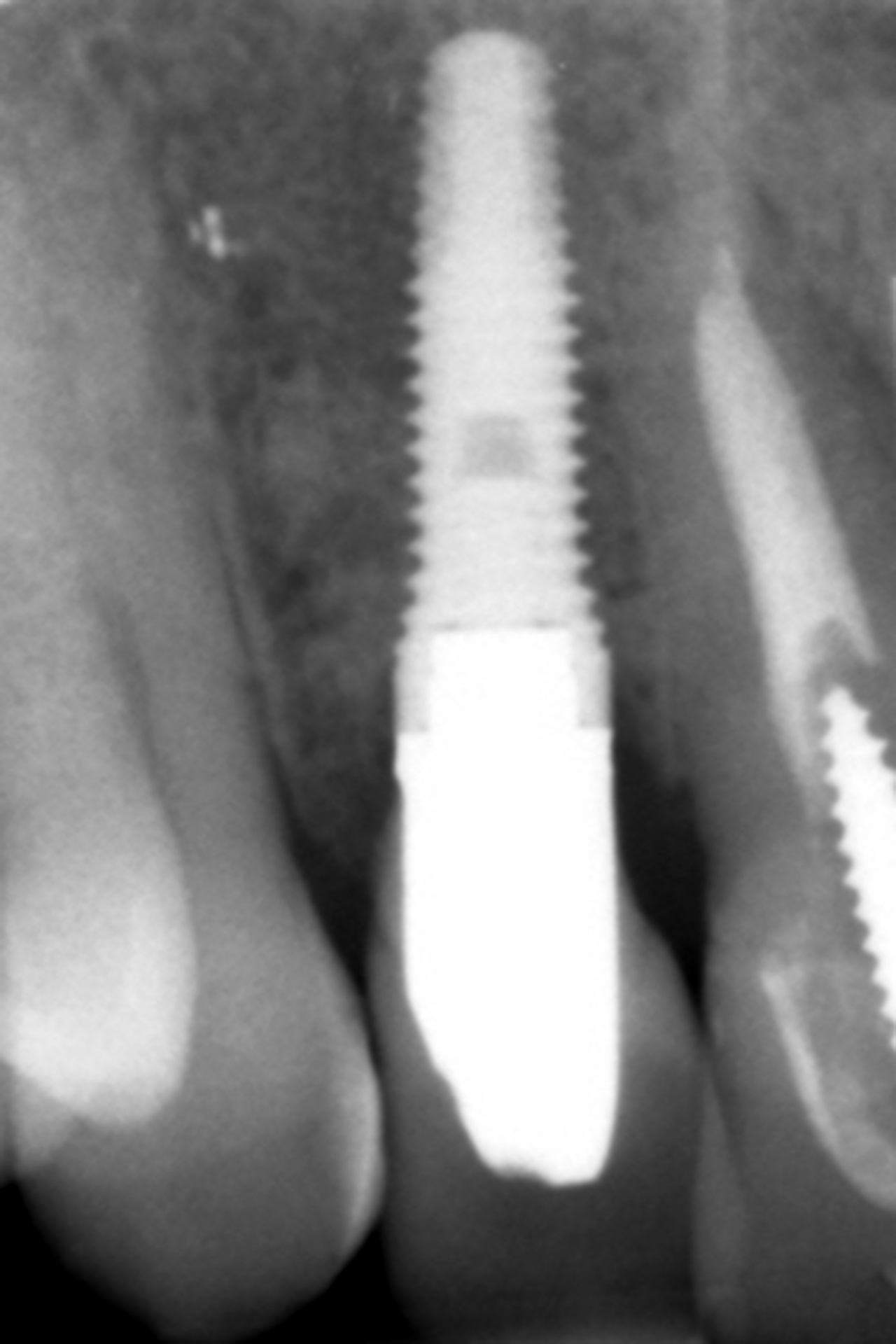 Implant explantation poorly positioned in an aesthetic sector and ...