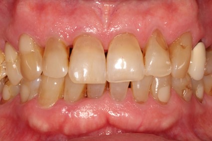 Figura 6. Imagen intraoral de la paciente.