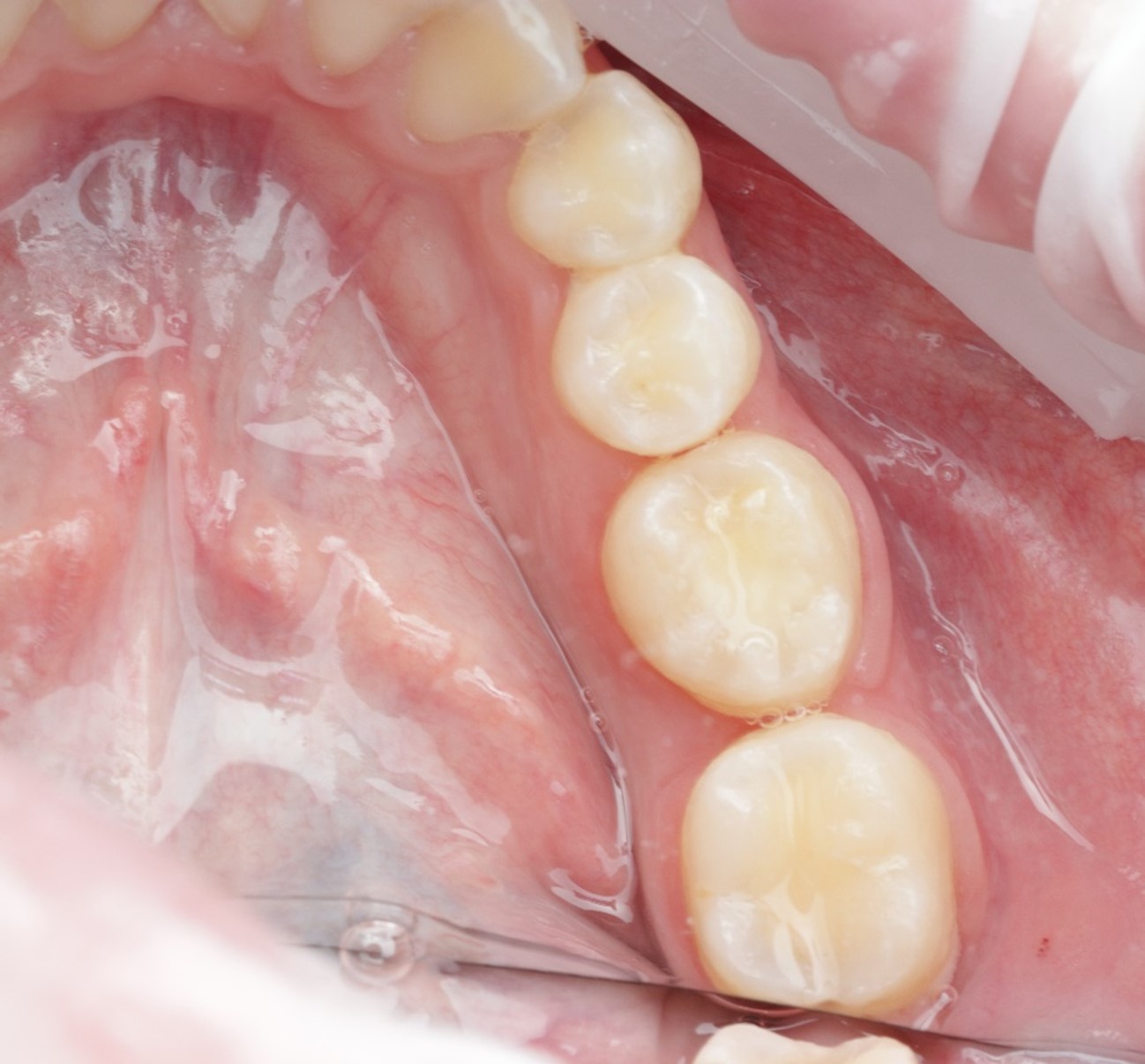 Figura 9. Imagen de seguimiento al año del autotrasplante