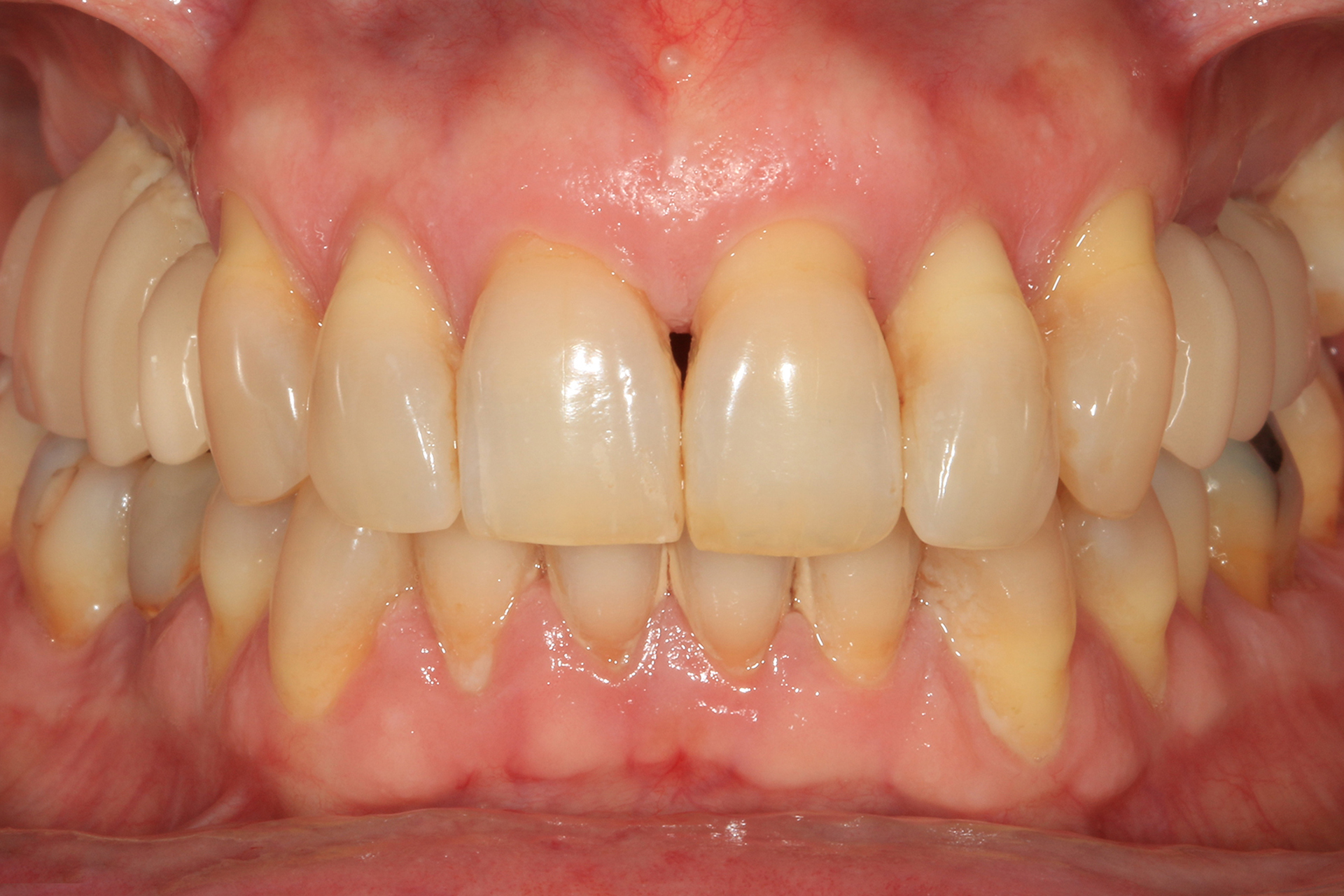 Figura 26. Imagen de la carga inmediata realizada en el paciente varias horas tras la colocación de los implantes dentales.