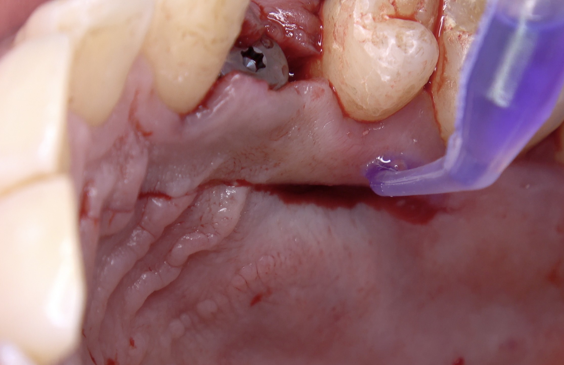 Figura 3. Aplicación de cianoacrilato en grupo test (GT).