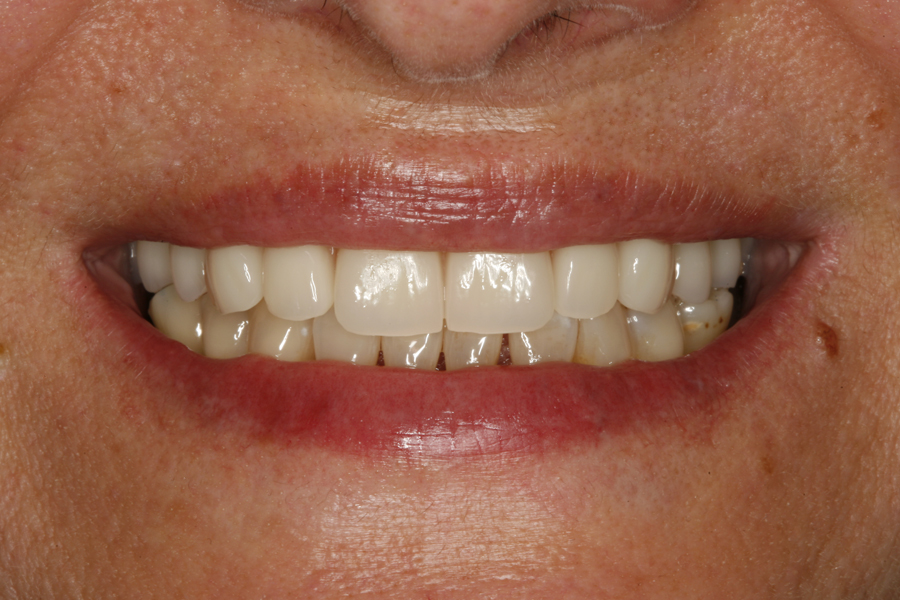 Figura 20. Imagen final de la sonrisa de la paciente a los 10 años del seguimiento.