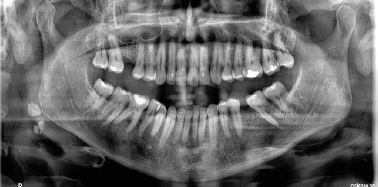Figura 9. Radiografía panorámica, se observan cálculos en glándula parótida derecha.