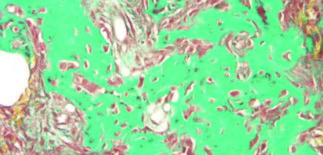Figura 7. Corte histológico teñido en tricrómico de Masson. Presencia de densidad moderada de tejido conjuntivo (Profs. Aguirre y Lafuente, SDPOMF).