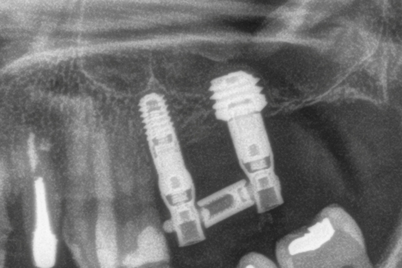 Figura 11. Imagen radiológica de la carga progresiva tras la segunda fase del implante.