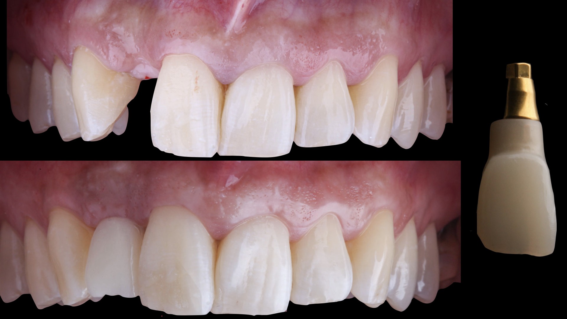 Figure 5. Direct implant provisional. A milled polymethyl methacrylate (PMMA) restoration was placed.