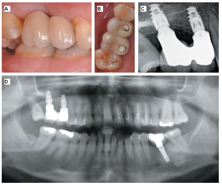 Figure 11. Images at six months post-loading. A. Lateral view of the implant-supported crowns. B. Occlusal view of the implant-supported crowns. C. Periapical radiograph. D. Panoramic radiograph.
