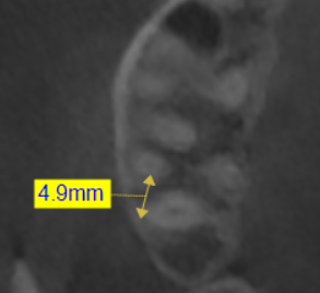 Figura 2. Distancia líneal del punto más distal de la raíz distal del segundo molar derecho hasta el borde interno de la cortical vestibular.