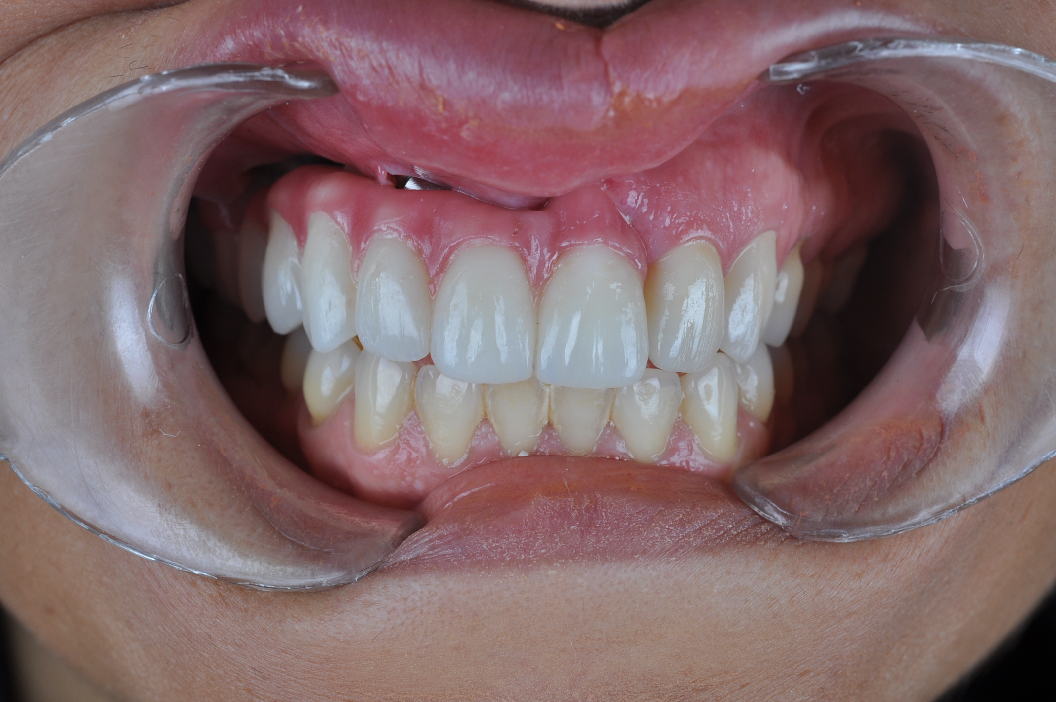 Figura 16. Fotografía intraoral con la rehabilitación definitiva en zirconio monolítico.