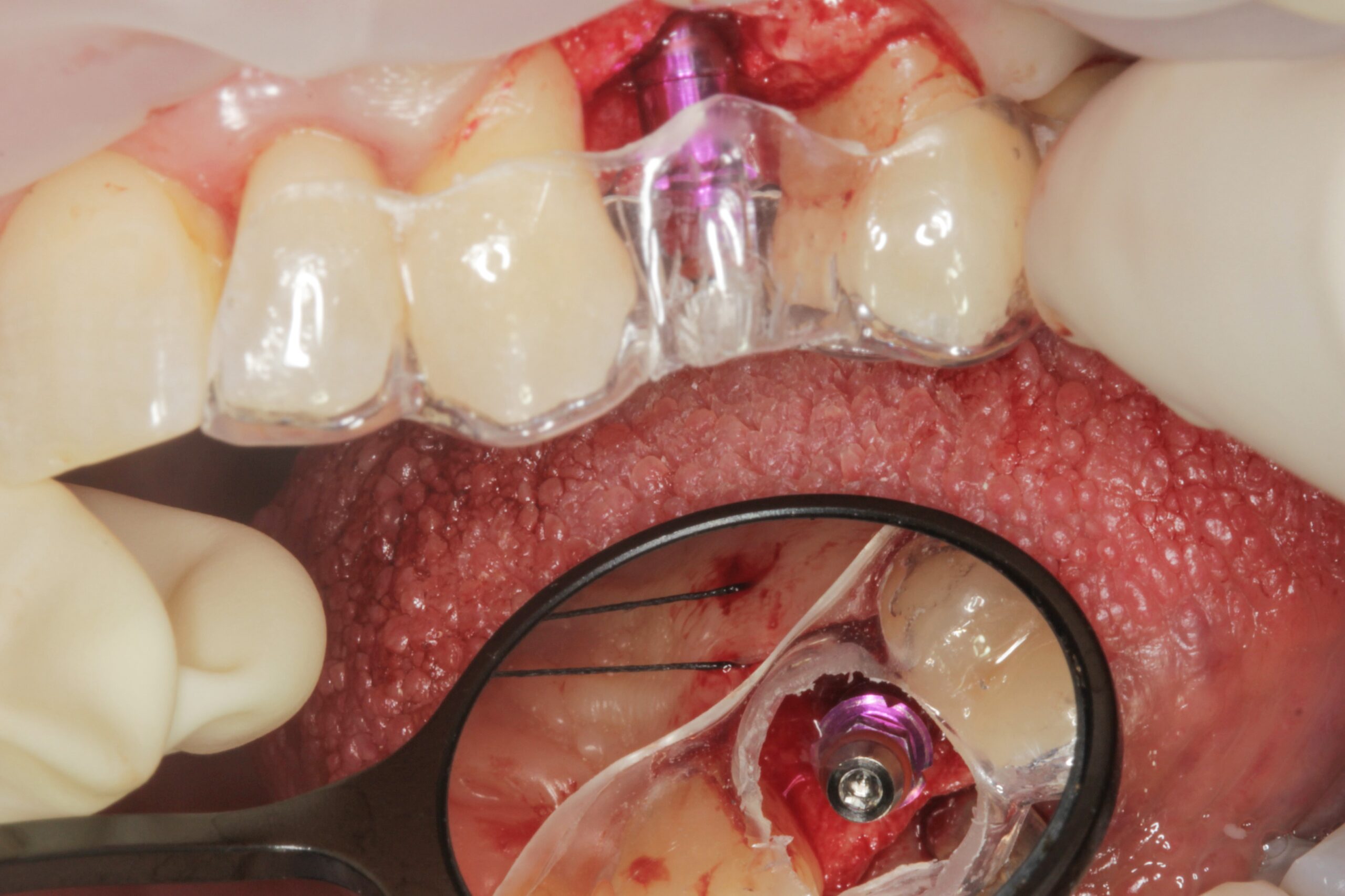 Figuras 8-11. Colocación del implante mediante cirugía guiada en la posición adecuada. En estas localizaciones donde el diámetro mesio-distal está reducido, este procedimiento nos ayuda a posicionar el implante en la mejor situación posible para su rehabilitación posterior.